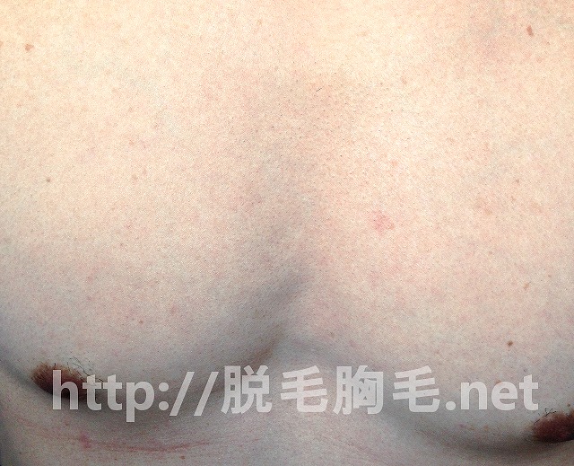 ケノン,脱毛,胸毛,効果,結果,その後